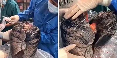 the charcoaled lungs of a person who smoked for 30 years